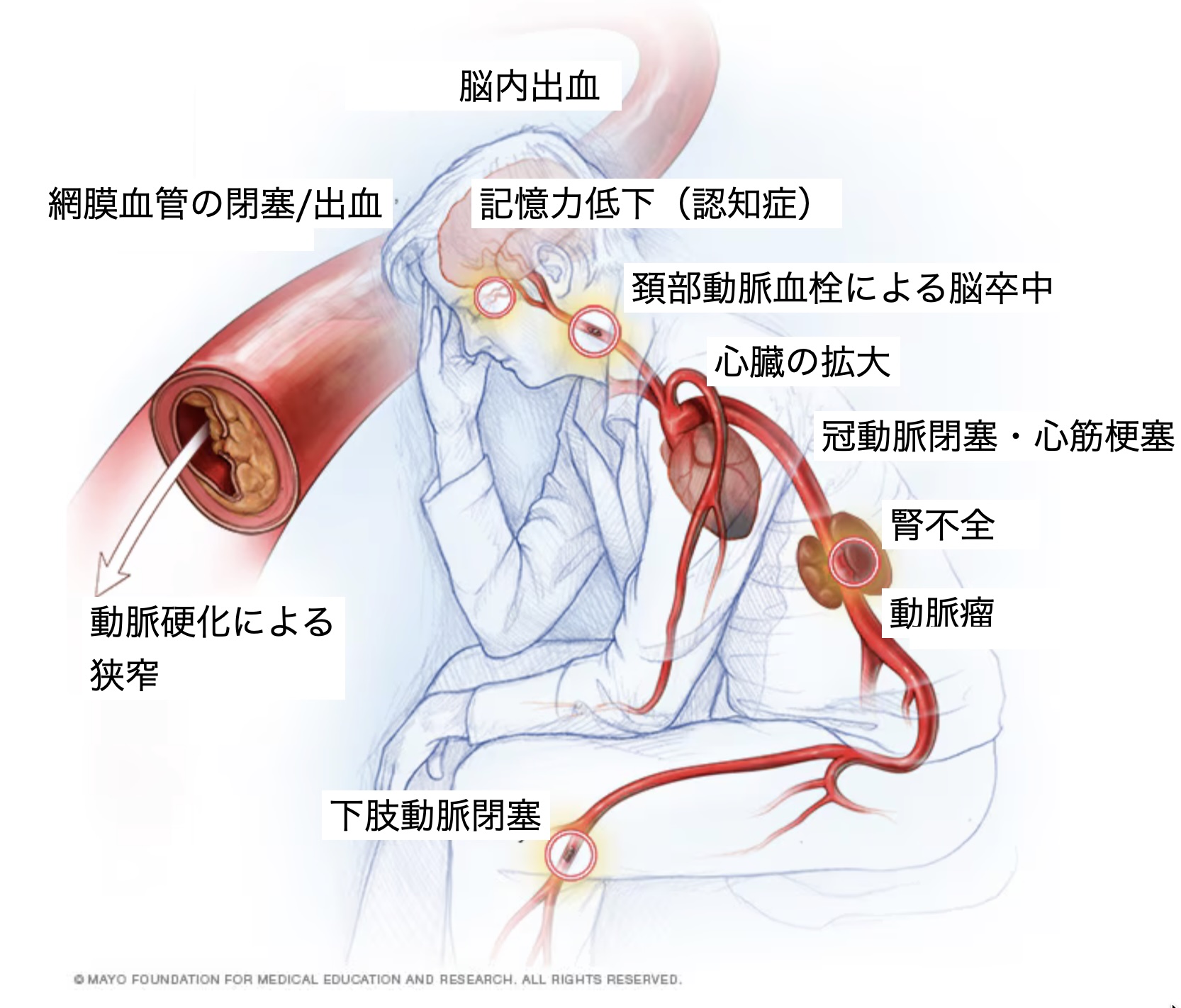 高血圧3 -人体の血管系と高血圧合併症 – 立正佼成会 徳島教会
